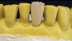 Figura 08 - Correção de desvio lateral mandibular e reposicionamento anterior