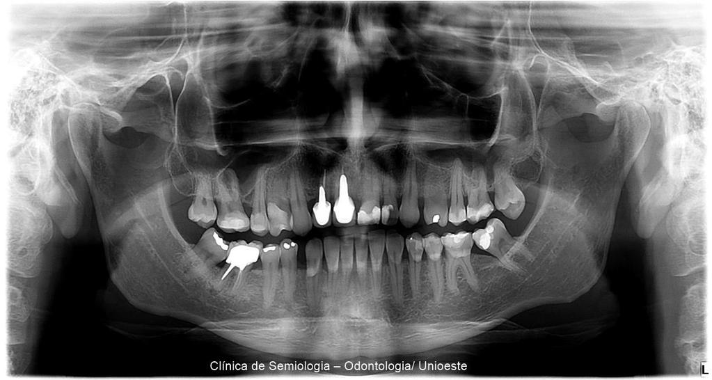 Exostose: Protuberâncias ósseas localizadas que surgem na cortical óssea. (NEVILLE,2016). Crescimento benigno. Maxila ou mandíbula. Tórus Palatino. Tórus Mandibular.