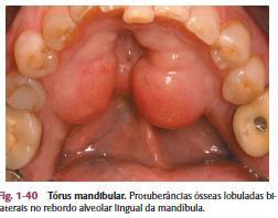 (Fonte: Neville, 2016). Cálculo/tártaro: Deposição calcificada. Dentes naturais, próteses e implantes. Placa mineralizada. Fator de risco para patologias periodontais.