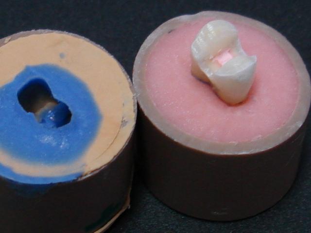 50 A B Figura 7: Moldagem do preparo: A) cilindro de PVC com silicone de consistência média posicionado sobre o cilindro de PVC com o dente preparado; B) molde removido do dente preparado 4.6.