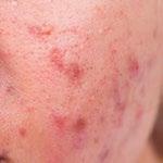 É mais fácil prevenir sardas e até manchas geradas após processo in- do que removê-las, por isso, todo cuidado é es- flamatório (acne). SKIN LIGHTENING β-white.