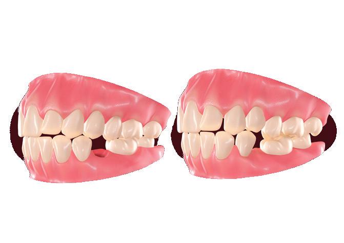 MODIFICAÇÕES DO OSSO DEVIDO À PERDA DE DENTES Em um dente saudável, a raiz transmite forças mastigatórias ao osso alveolar.