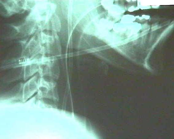 Oximetria de bulbo jugular Determinar a SjO 2 Método