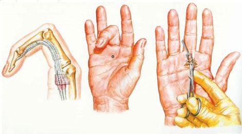 Como é depois da cirurgia? Mesmo com a colocação do curativo é permitido, e aconselhado, ao paciente movimentar livremente os dedos da mão.
