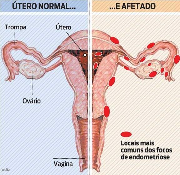 Apesar de vários estudos, até agora as causas que levam ao desenvolvimento da endometriose ainda não se encontram muito bem esclarecidas, mas sabe-se que a união de vários fatores como: hormonais,