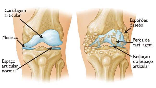 4 Figura 3 - A osteoartrose resulta frequentemente no atrito entre os ossos. Esporões ósseos são uma manifestação comum dessa forma de artrite. Fonte: http://orthoinfo.aaos.org/topic.cfm?