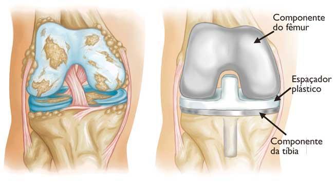as superfícies dos ossos são efetivamente substituídas. Há quatro etapas básicas no procedimento de artroplastia do joelho.