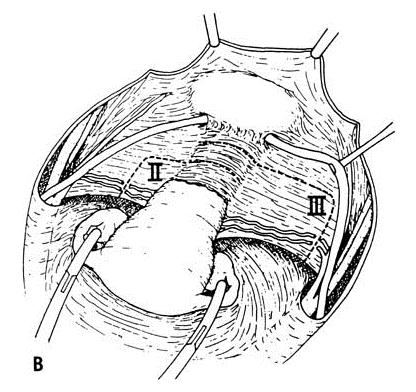 inguinal. Incluindo, ainda, esvaziamento linfonodal da fossa obturadora (4, 5, 22).