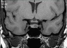 20 hipotireoidismo primário pode resultar em hiperplasia hipofisária (Atchison et al., 1989), levando ao diagnóstico equívoco de prolactinoma ou pseudoprolactinoma.