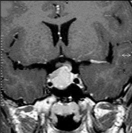 Tratamento Figura 1B: Ressonância magnética de sela túrcica, sequência pesada, em T1 com contraste, corte coronal, evidenciando lesão com impregnação homogênea pelo contraste, localizada na sela