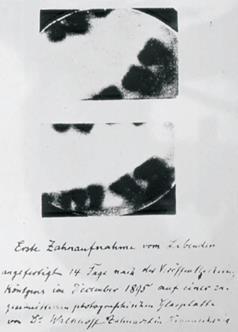 Figura II: Primeira radiografia realizada pelo Dr. Walkhoff aos seus próprios dentes (2).