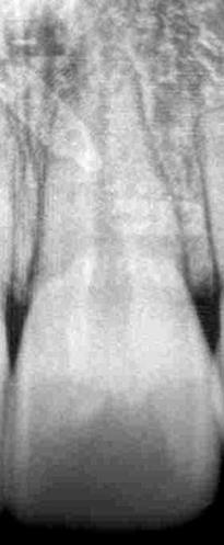 2.2.4- Radiografia periapical Técnica radiográfica intraoral em que há uma sobreposição reduzida das estruturas anatómicas, permitindo uma visualização direta dos dentes e do osso alveolar com menor