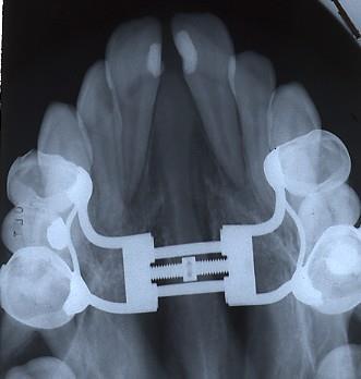 Figura V: Radiografia oclusal de paciente portador de aparelho fixo de expansão com parafuso Hyrax. Exame de controlo, após a expansão da sutura média palatina. 2.
