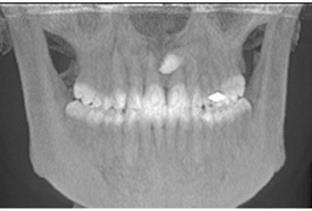 Figura VIII: Telerradiografia frontal do andar inferior da face. É possível observar a inclusão do 23