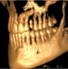 A TAC tem algumas limitações nomeadamente no diagnóstico de fraturas dentárias que estão abaixo da sua capacidade de resolução e pode resultar em falsosnegativos. (22