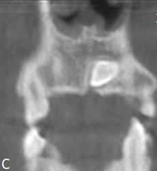 (30), uma determinação tridimensional fornece ao clínico informações precisas acerca da posição do canino,