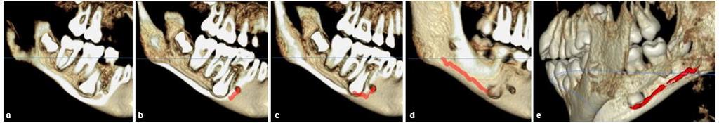 observar com precisão o posicionamento das várias estruturas anatómicas, tal como é possível observar na figura XVI. Figura XVI- Reconstruções 3D de imagens DICOM.