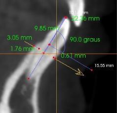 e o trajeto do nervo alveolar inferior. 2.4.