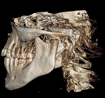 Figura XIX: Reconstrução tridimensional do 1/3 médio e 1/3 inferior da face. Excelente para avaliação da articulação temporo-mandibular. 2.4.