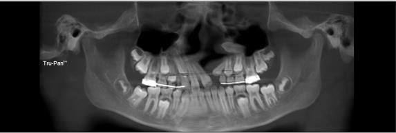 Figura XX: TCFC para visualização das dimensões transversais do maxilar superior e osso alveolar vestibular dos dentes posteriores superiores em paciente com Quad-Helix. 2.4.