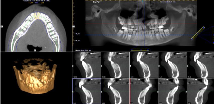 Figura XXI: Conjunto de imagens obtidas via TCFC de um paciente com fenda lábio-palatina esquerda. 2.4.9.