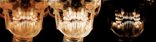 2.4.10- Medições do diâmetro mesiodistal de dentes permanentes ainda não erupcionados, para avaliação da discrepância dento-maxilar em dentição mista Com a TCFC, e graças às suas propriedades, é