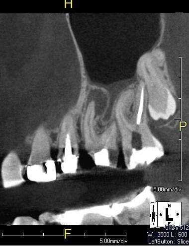 157 Figura 1: Radiografia inicial No exame radiográfico, não foi detectado a presença do canal MP.