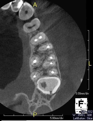 A B Figura 2: Imagem de TCFC demonstrando a presença do canal MV (A) corte sagital, (B) corte axial.