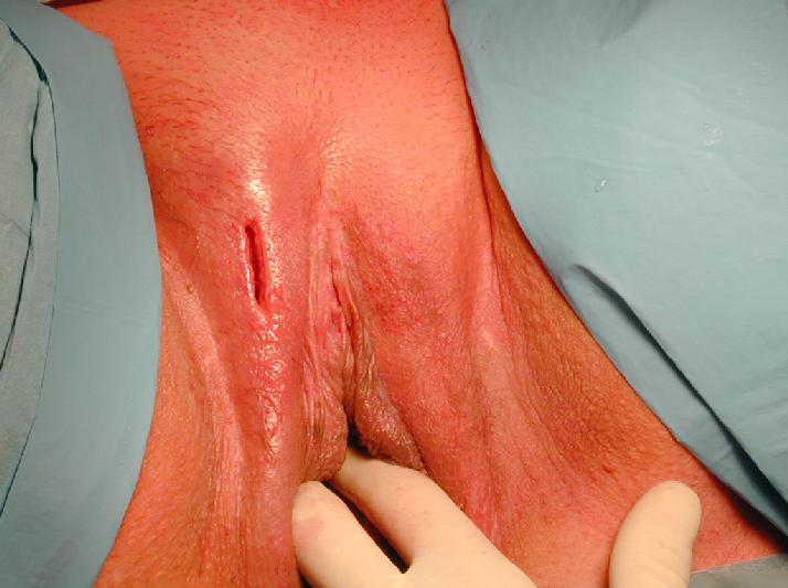 Celulite Vulvar