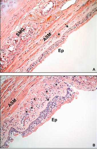 ASM= músculo liso brônquico, M= muco, Ep= epitélio e C= cartilagem. Adaptado de Maud et al, 2007(12). Figura 2.3 A: mucosa brônquica normal.