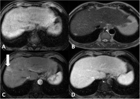Fig. 5 - Nódulo displásico de alto grau. (A) Imagem RM axial em T1, (B) T2, (C) T1 pós-contraste na fase arterial e (D) venosa, com saturação de gordura num doente com cirrose hepática.