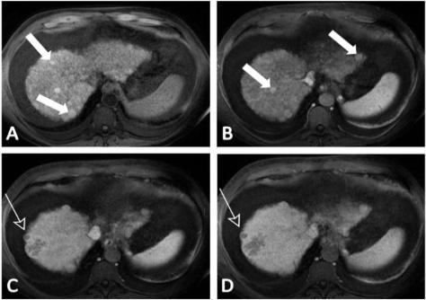 imagens pré-contraste (A e B), características que são compatíveis com um nódulo displásico de alto grau. Fig. 7 - Pequeno carcinoma hepatocelular.