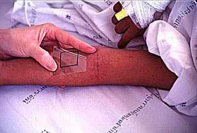 PROVA DO LAÇO: Desenhar um quadrado de 2,5 cm de lado (uma polegada) no antebraço do paciente.