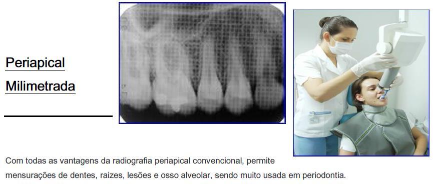 24 RADIOGRAFIAS INTRABUCAIS PERIAPICAL BOCA TODA: São realizadas 14 radiografias possibilitando examinar todos os dentes e estruturas adjacentes com