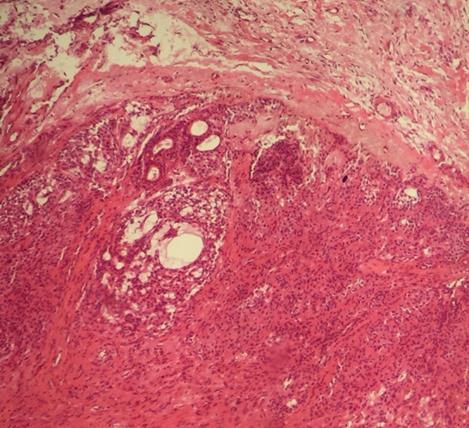 O tumor era delimitado por cápsula fibrosa embora houvesse áreas de infiltração celular, e o diagnóstico histopatológico compatível com Adenoma Pleomórfico