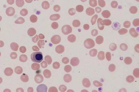 Recomendações do ICSH Série Vermelha Inclusões eritrocitárias ERITROBLASTOS - São precursores eritrocitários descritos normalmente como Eritroblastos quando encontrados no sangue periférico.