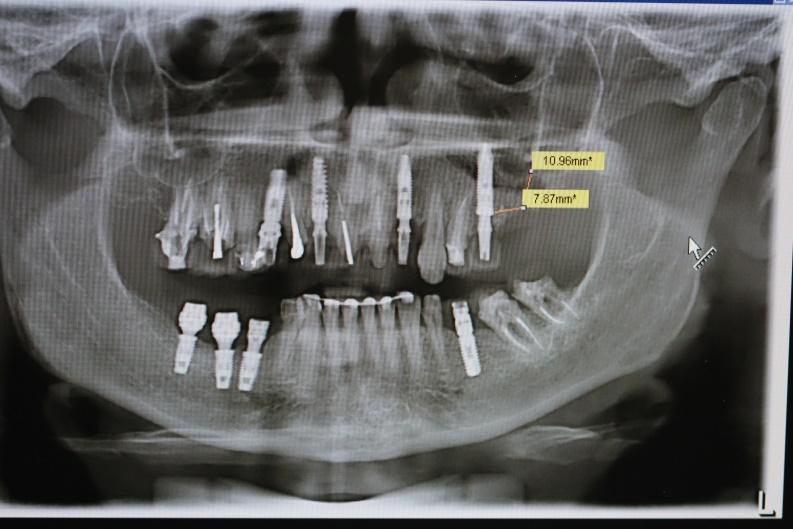 43 Figura 10 Radiografia panorâmica 60 dias após a extração. A instalação de implante no local foi feita 90 dias após a remoção do elemento dental.