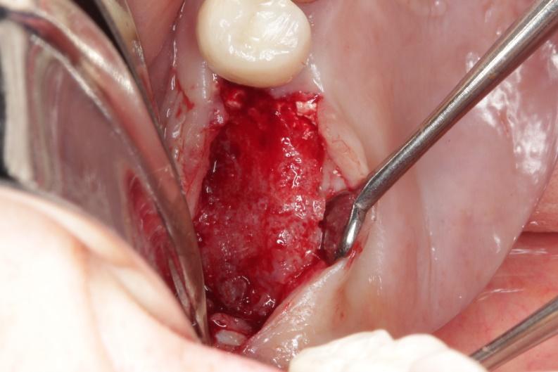 Com o afastamento dos tecidos moles, pode-se observar a neoformação óssea, indicando o sucesso do procedimento (Figura 11). Figura 11 Neoformação óssea pós-exodontia.