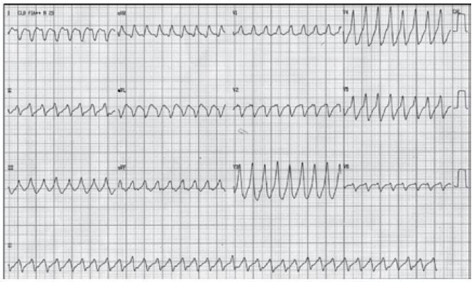 Página: 5 de 9 - Para o diagnóstico de TSV pré-excitada, a presença de intervalo RR irregular e resposta ventricular elevada (acima de 180 bpm), sugere o diagnóstico de fibrilação atrial conduzida