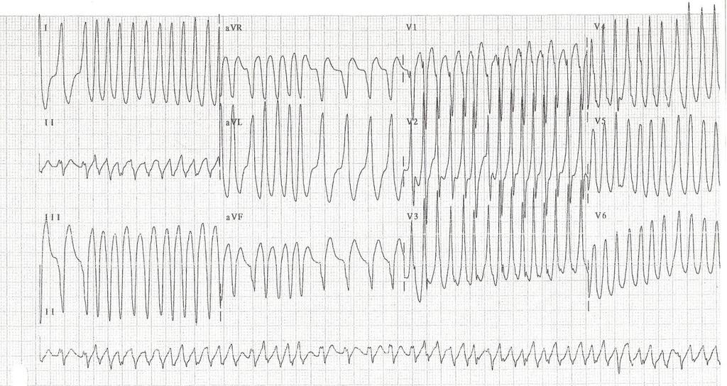 Supraventricular