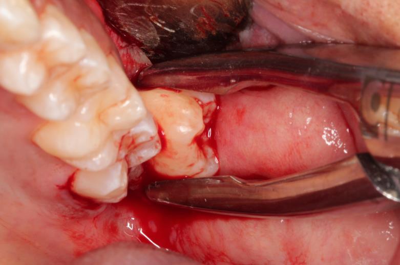 4), a exodontia do dente a ser transplantado foi realizada com bastante cautela.