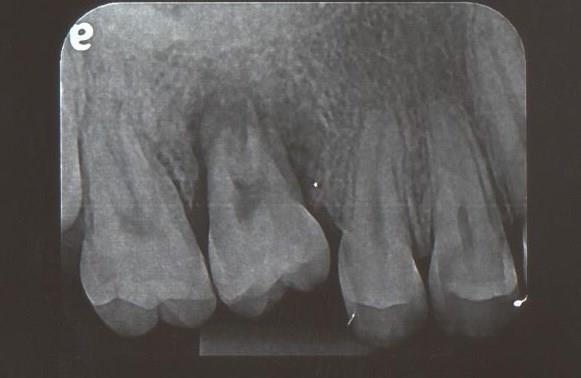 14 No dia 25/07/2013, sete dias após a cirurgia a paciente foi examinada encontrando-se com cicatrização normal e mobilidade grau III no dente que foi submetido ao transplante.