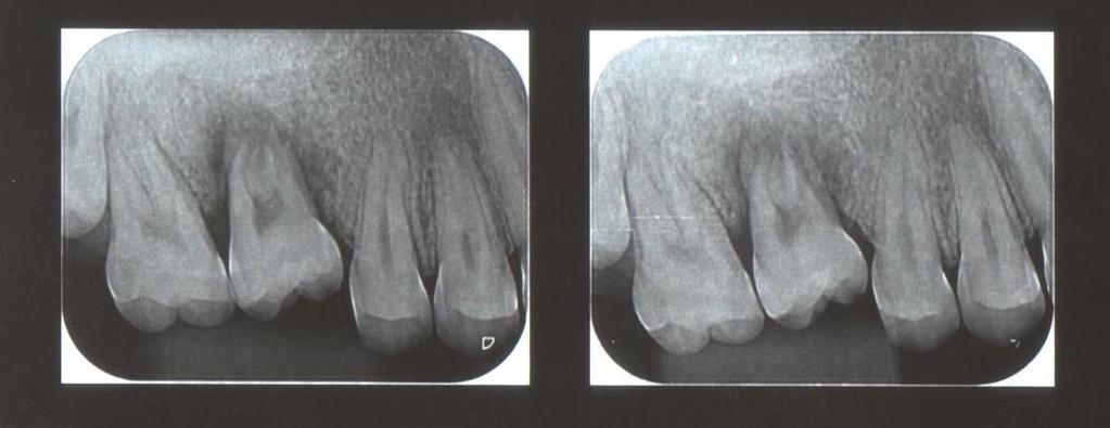 No dia 08/08/2013, vinte e um dias após o transplante, o dente apresentava grau III de mobilidade, epitélio com coloração normal e ausência de recessões.