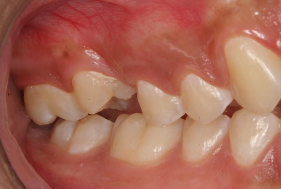 15 No dia 08/09/2014, a paciente foi atendida para o exame de um ano pós-operatório, foi realizado teste de vitalidade pulpar e o dente transplantado respondeu positivamente.