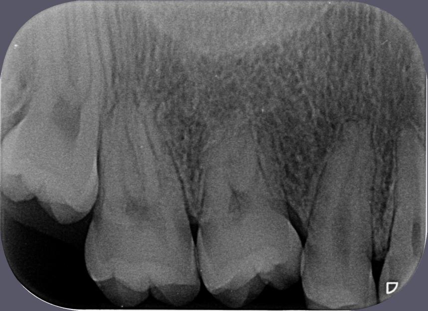 16 Figura 12- Radiografia periapical de um