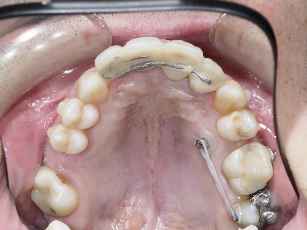 Assim, a verticalização dos molares deve anteceder a mesialização de modo a