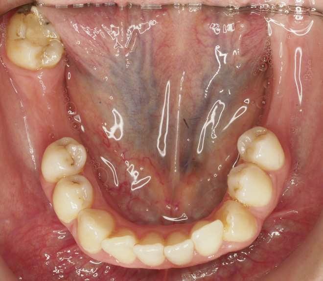 Como uma alternativa viável e segura para a colocação de miniimplantes, para auxiliar este tipo de movimento, tem-se utilizado a linha oblíqua externa, como ilustramos nesta situação.