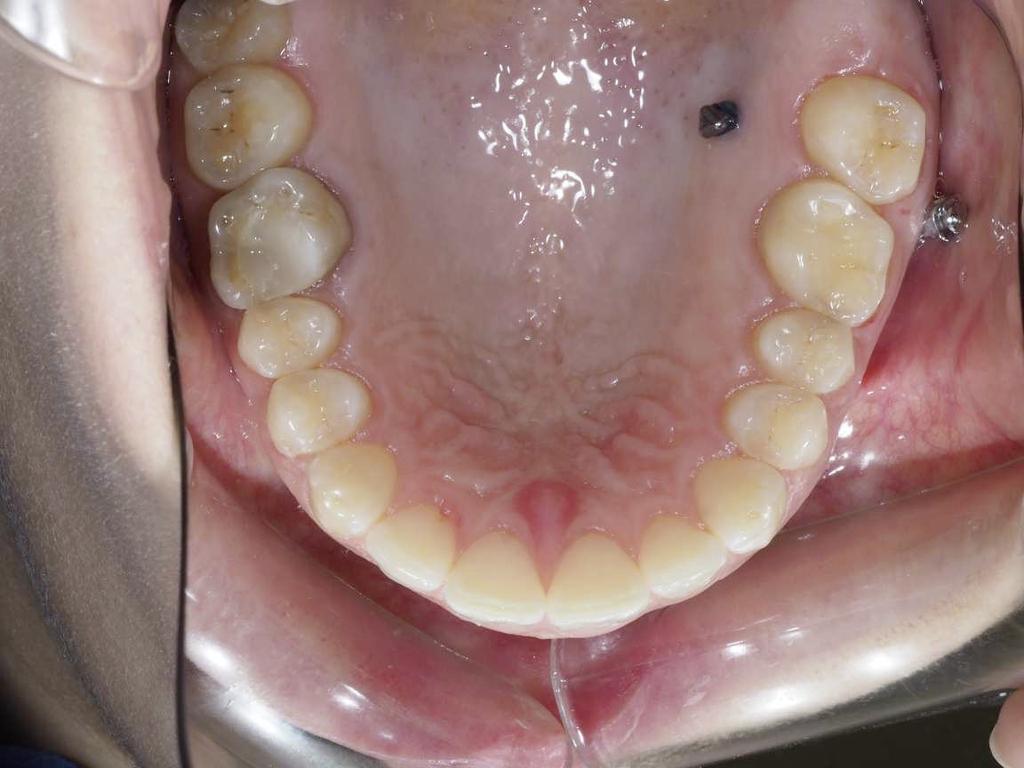 dentária. Quando se registam estes desvios de inclinação axial na dentição superior e inferior, podem utilizarse elásticos intermaxilares para correção da mordida.