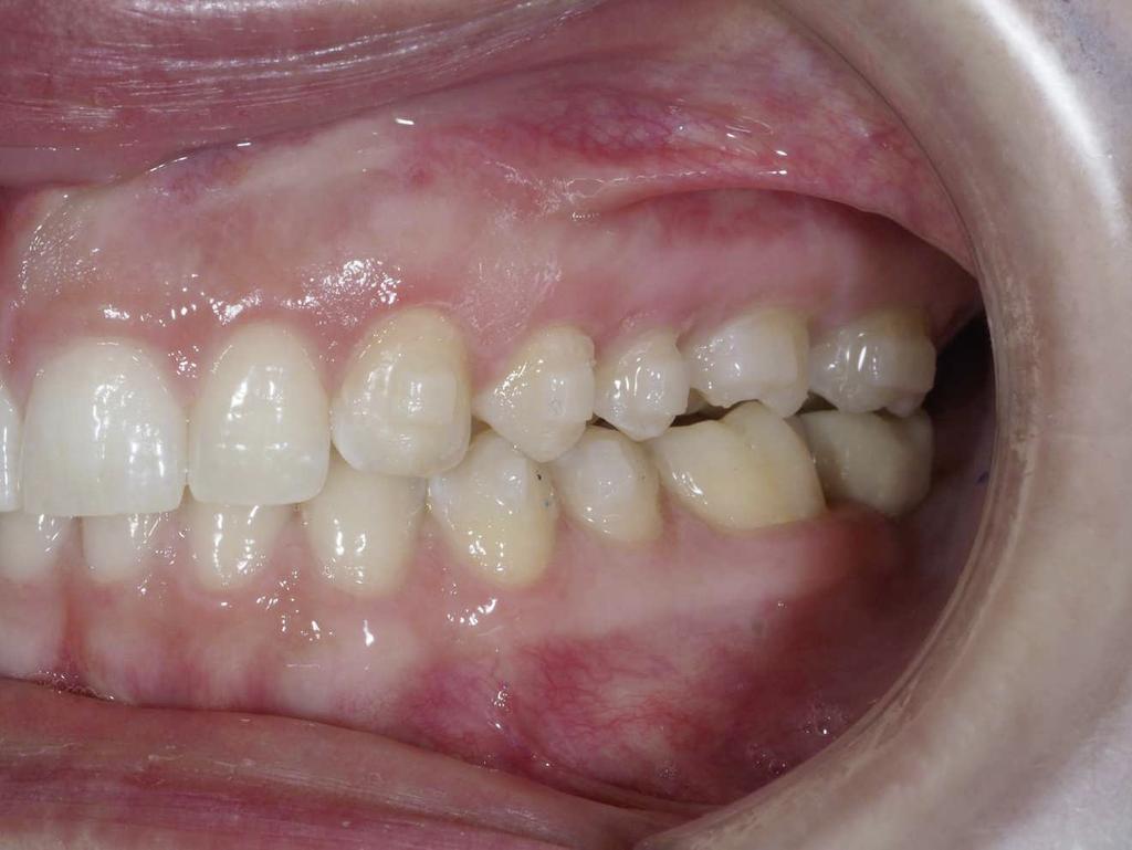 coloque um ou dois mini-implantes no lado oposto à inclinação, ou seja, por palatino (na rafe palatina entre o 1º e 2º molar) na maxila e por vestibular na linha oblíqua