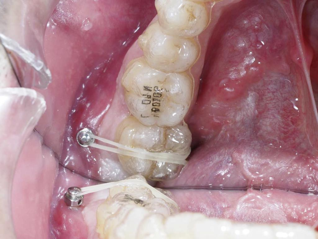 Invisalign. d e Figura 6.